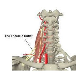 thoracic-outlet